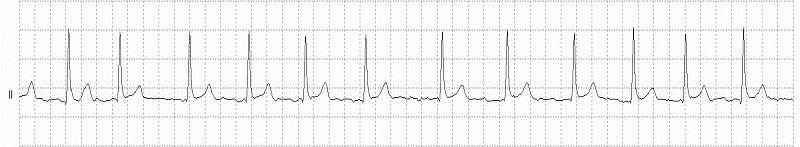 Atrial Fibrillation Rhythm Strip_fig3